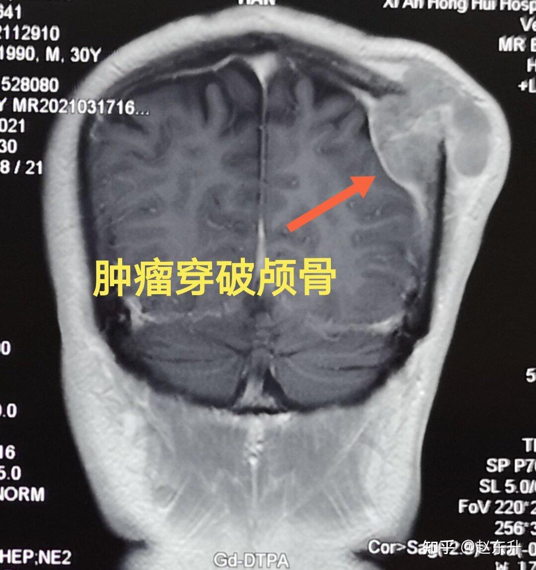 贺晓生教授：右侧矢状窦旁、镰旁脑膜瘤切除（实例） - 微医（挂号网）