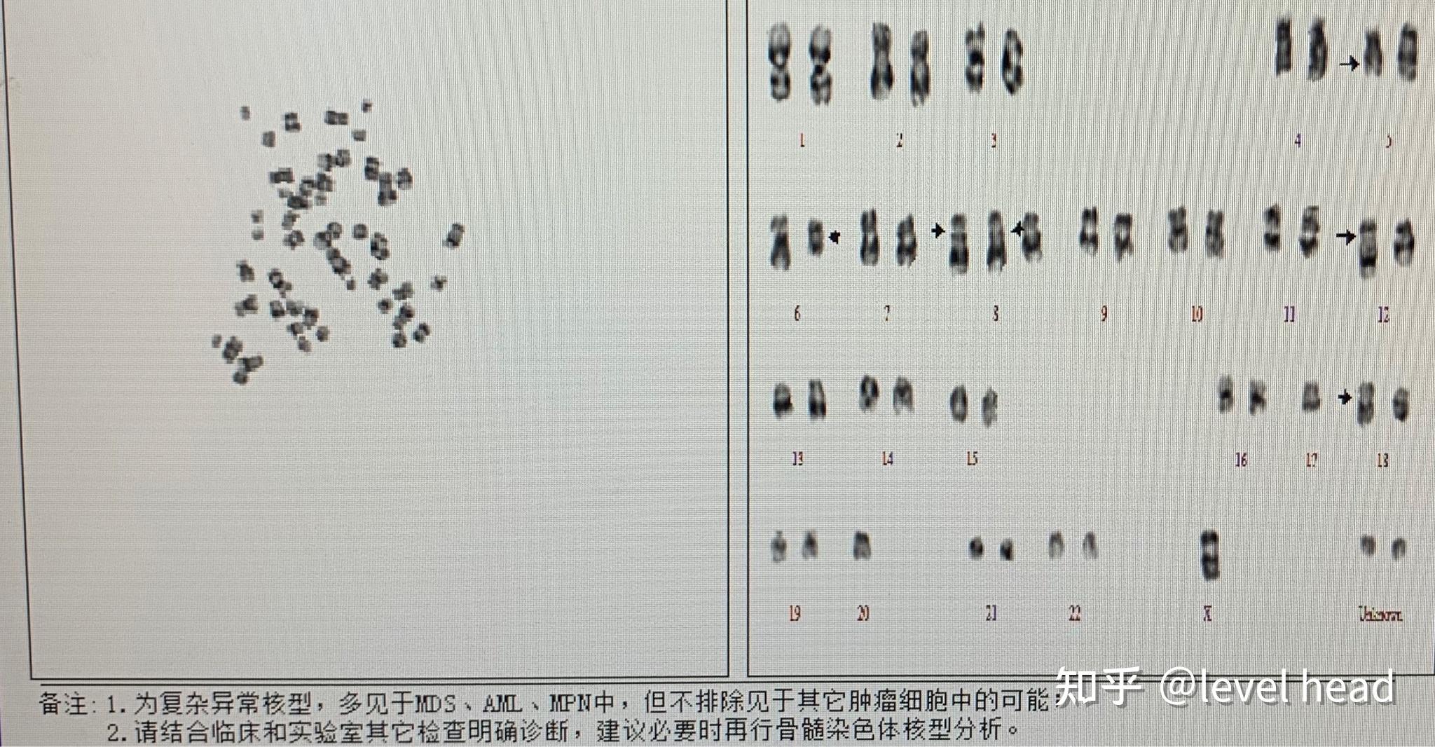 中主要了討論在染色體異常方面的分型,這篇是主要結合fish檢測來討論