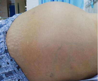 肚子里积水腹水从中医入手如何治疗腹水