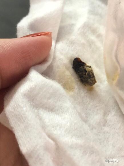 真的有"耳结石"这回事吗?