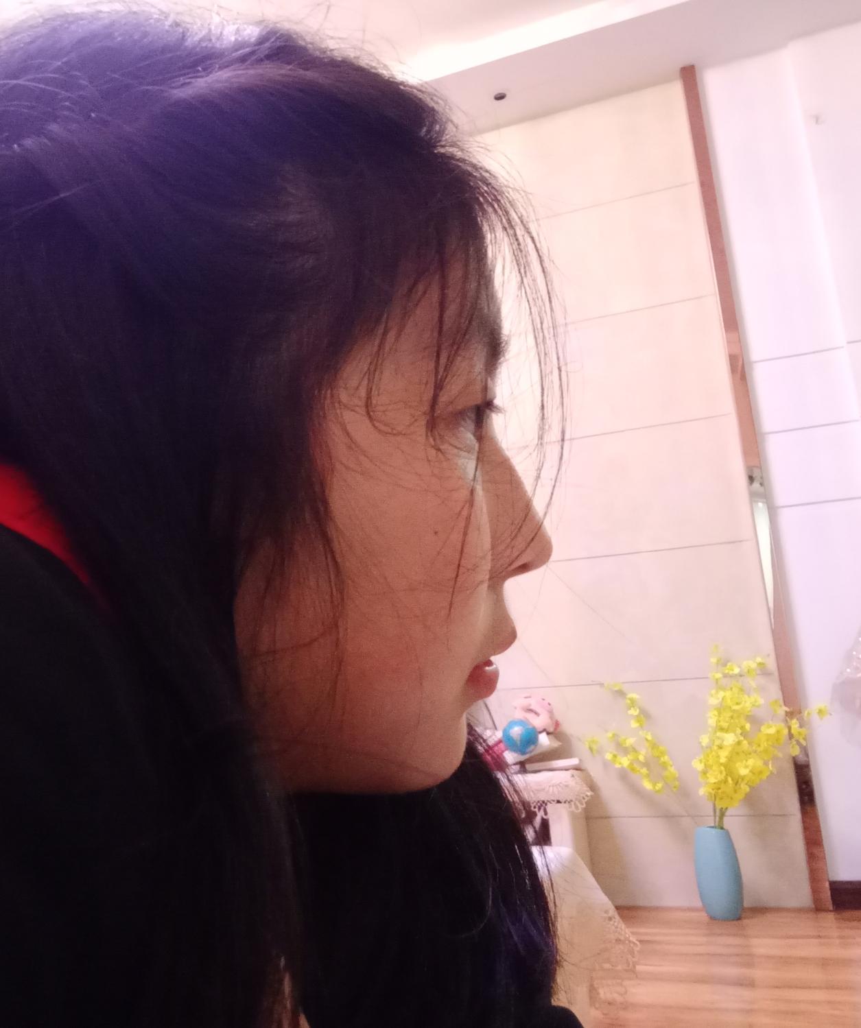 侧面看眼睛非常突眉骨低和鼻子连接不起来是怎么回事