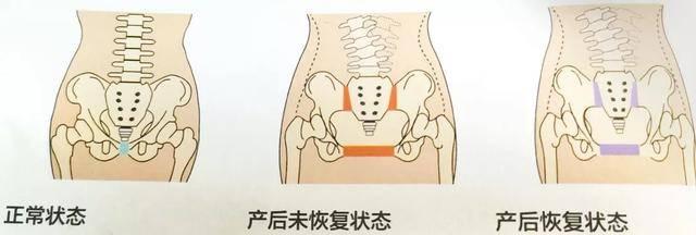 耻骨联合分离 产后难以言语的痛 知乎