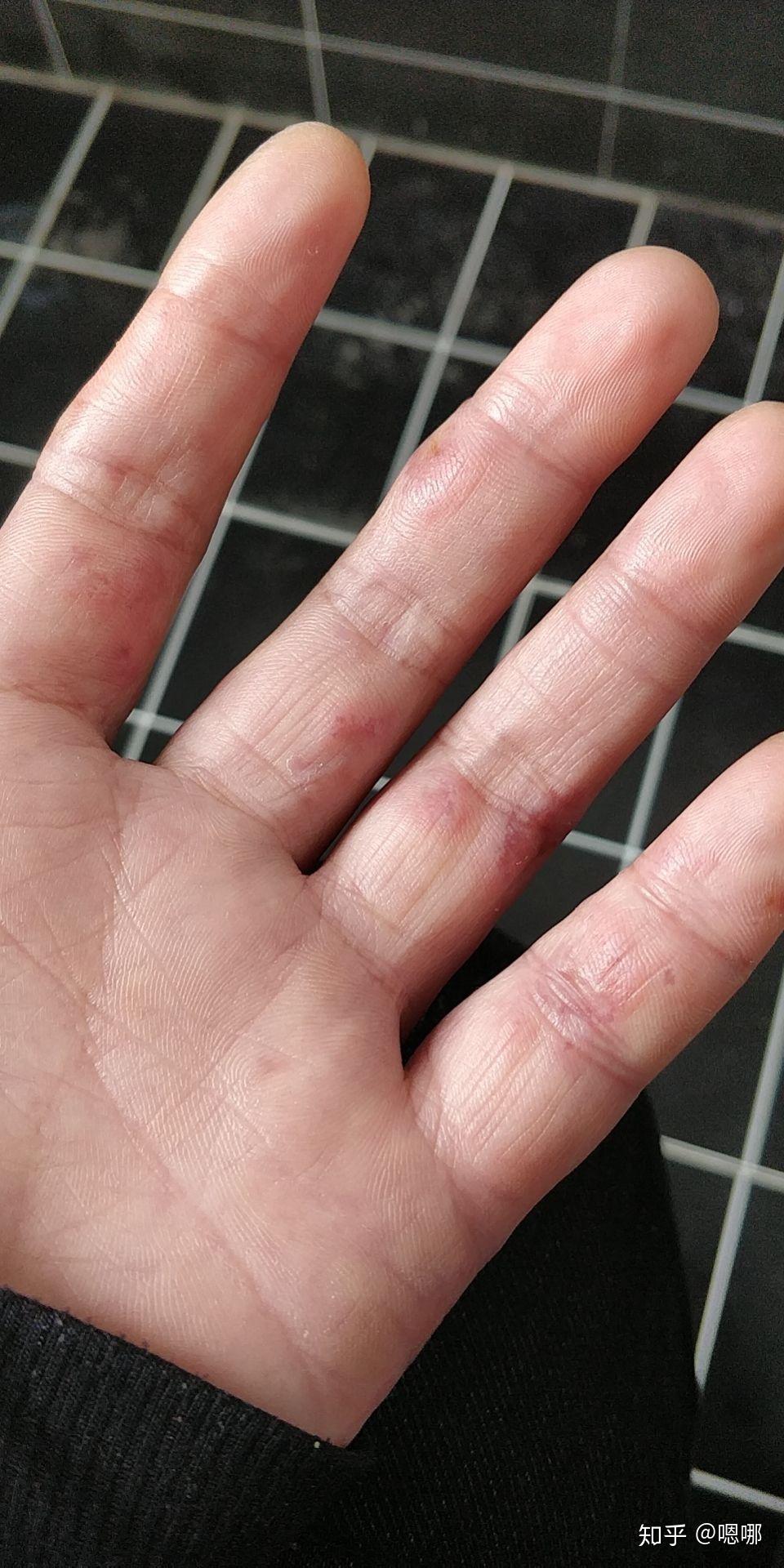 你都用过什么神奇偏方冻手