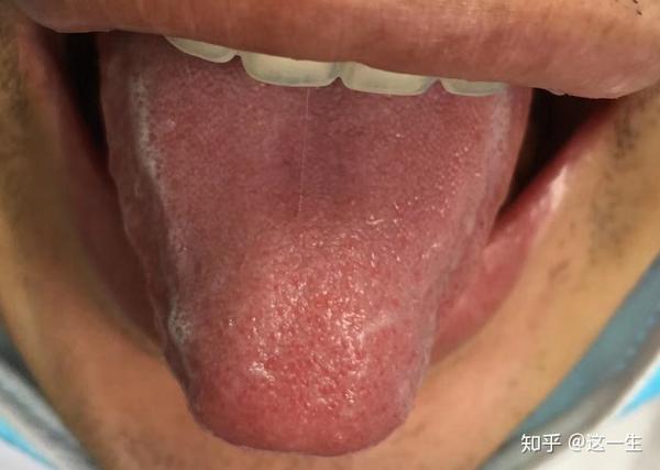 舌头上两条唾液线图片图片