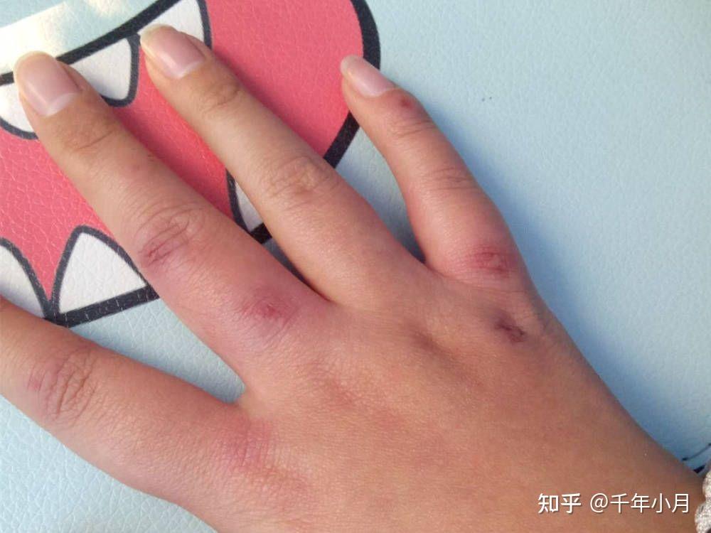 冬天冻手冻脚怎么办