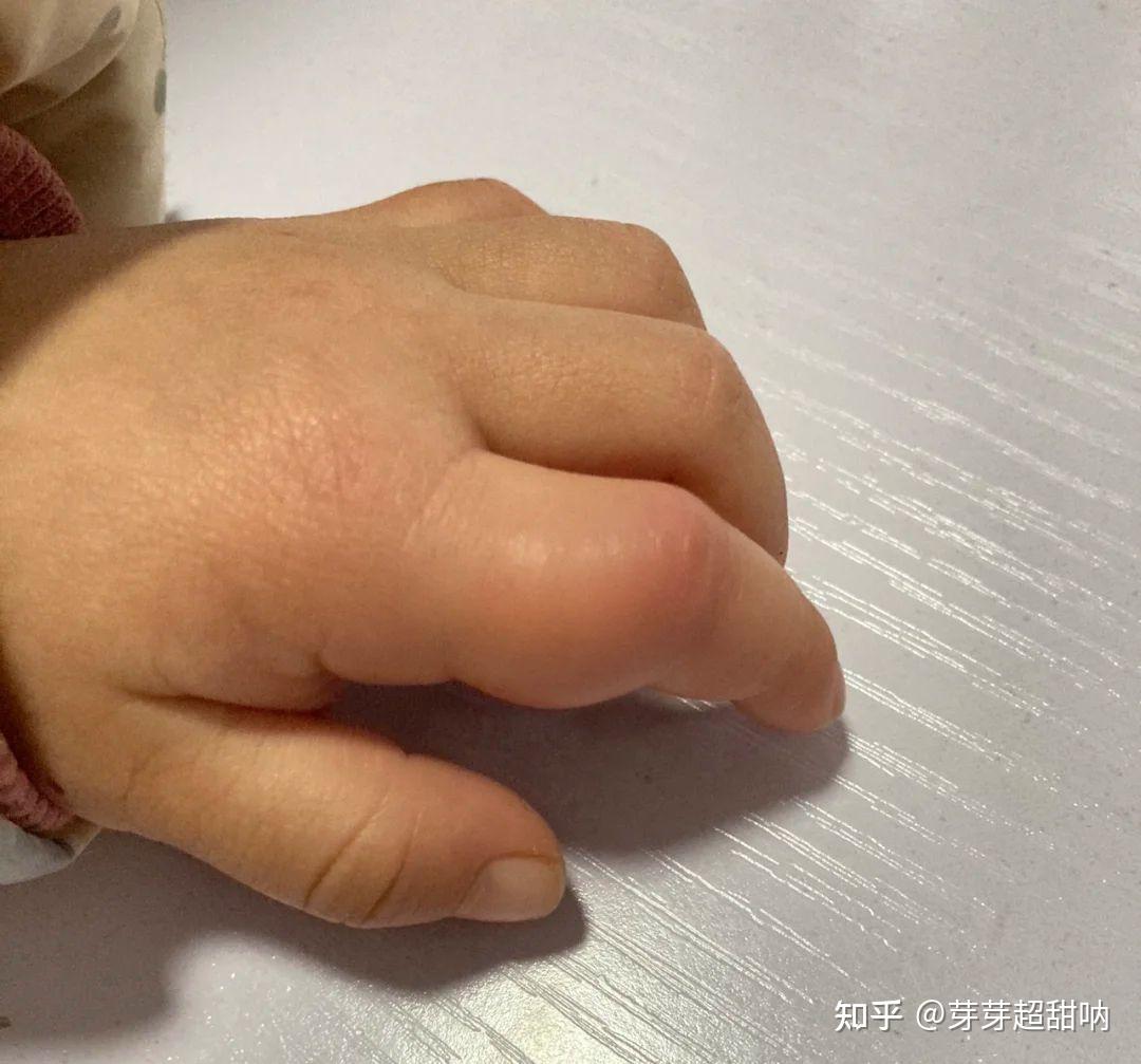 铁锤的手上原来能明显看出来冻疮,表面上红肿红肿的,看着就很让人心疼