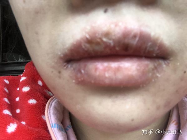 唇炎唇干裂脱皮流黄水怎么办