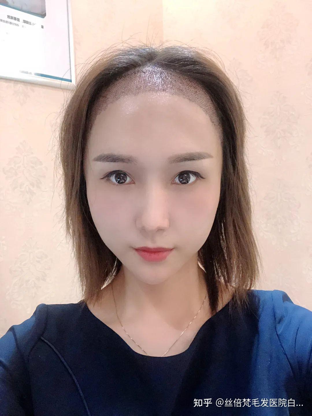 植发三个月能洗头吗知乎(植发三个月能洗头吗知乎推荐)