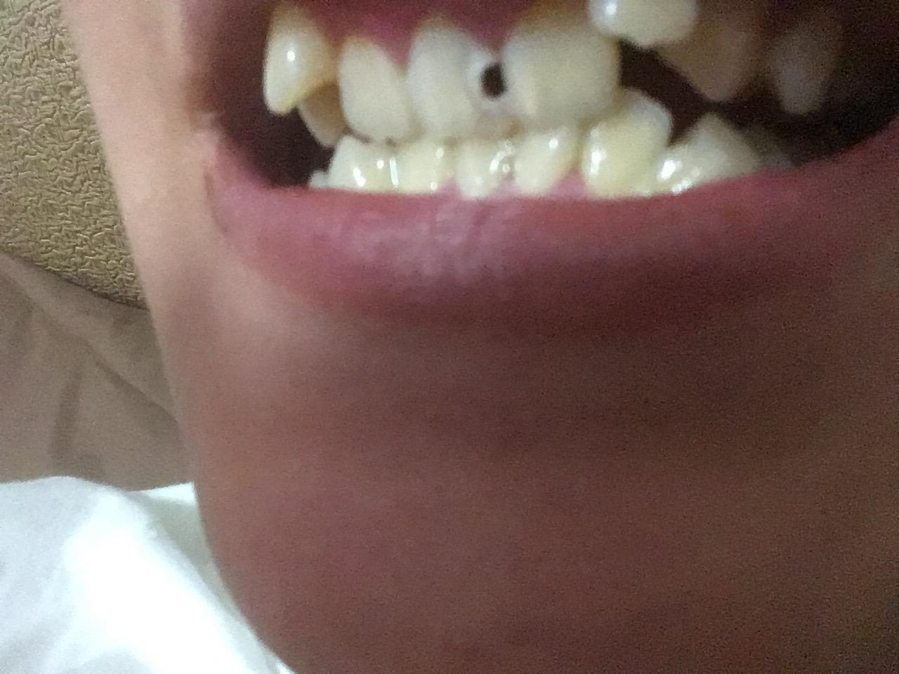 门牙有个小洞什么情况?