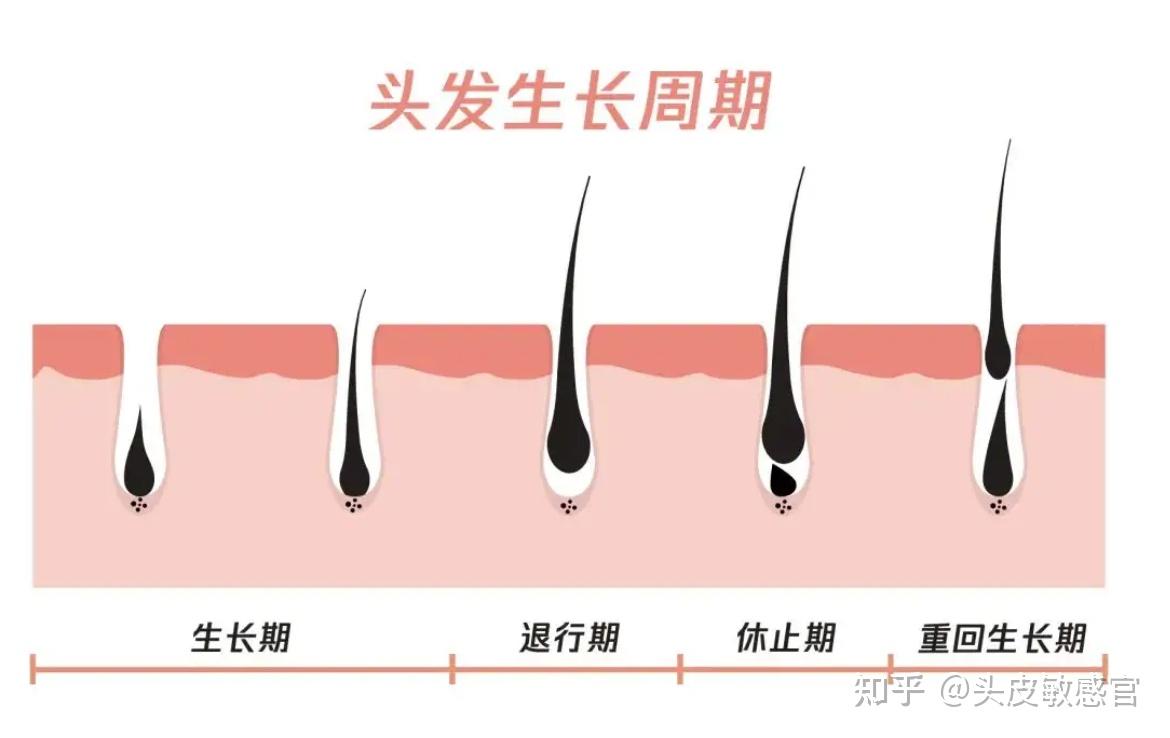 雄激素性脱发,斑秃等多种脱发类型i休止期脱发:是因为生长期的头发