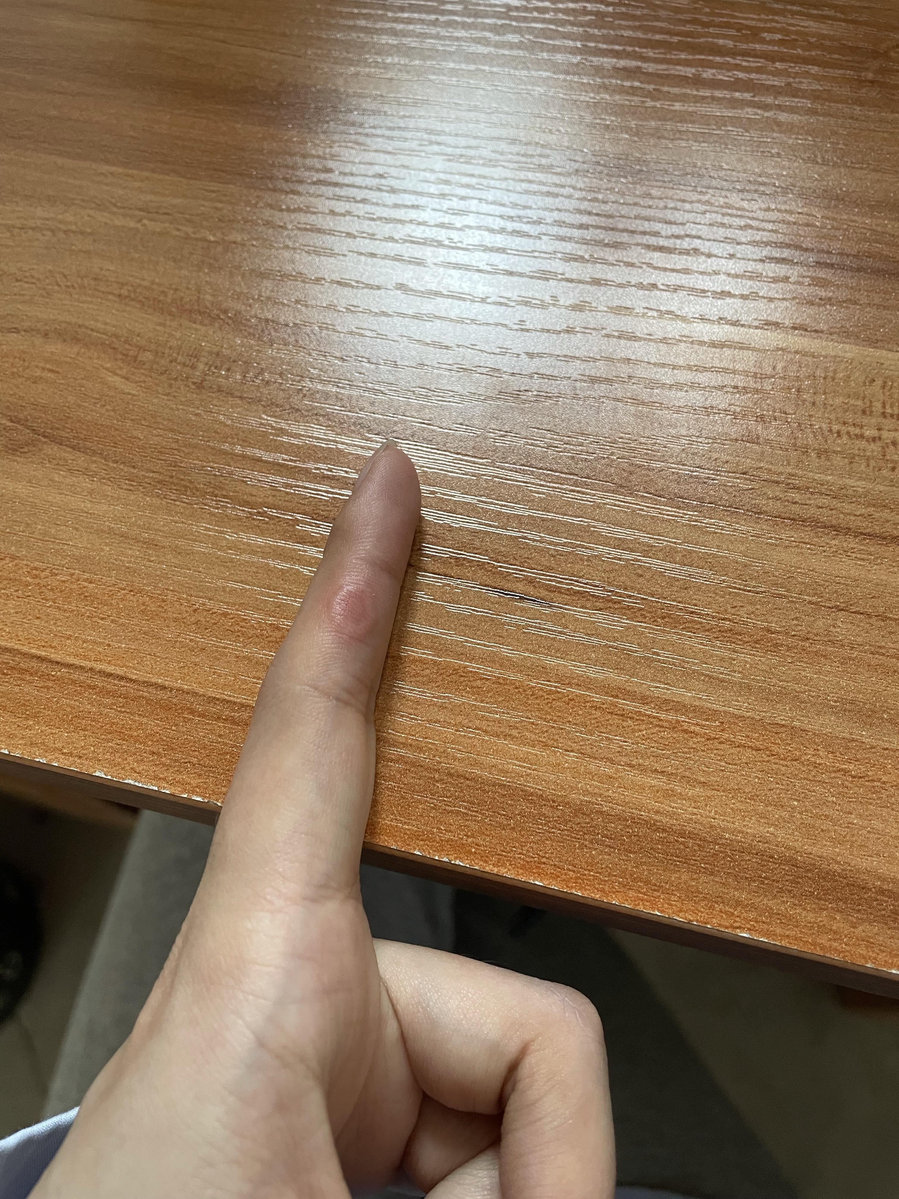 环状肉芽肿是由于压力引起的吗? - 知乎