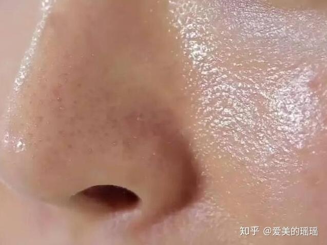 在控制脸上出油后,毛孔能渐渐恢复么? - 知乎