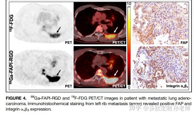 文献分享：68Ga-FAPI-RGD显像成纤维细胞活化蛋白FAP和整合素avb3对不同癌症类型中的临床评价 - 知乎