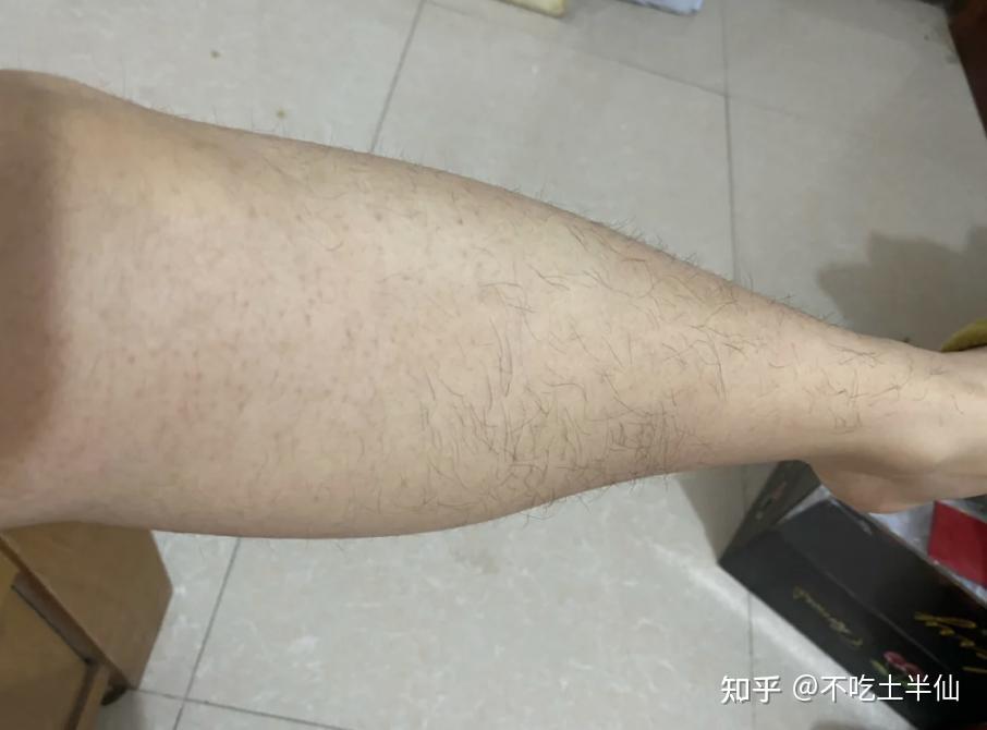 鸡皮肤里面有腿毛怎么去除(鸡皮肤里面有腿毛怎么去除图片)