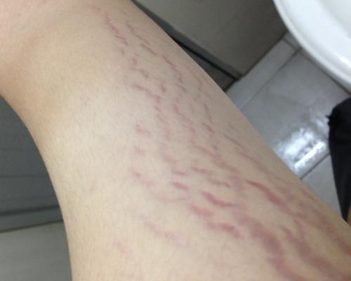 肥胖纹的形成,看完叫你大吃一惊 纹妍纹推荐