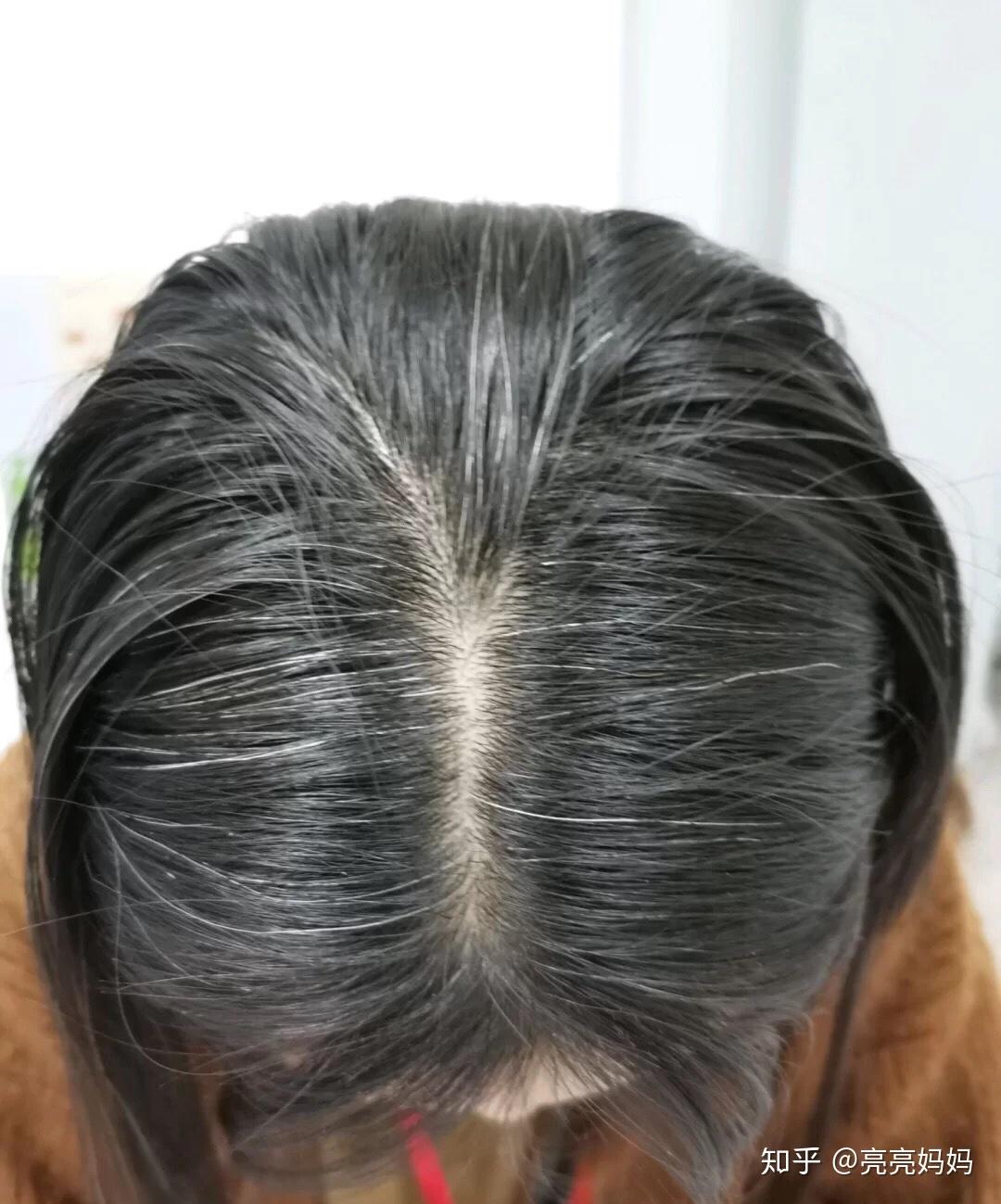 白头发终于可以变黑了历经3年的治疗白头发历程艰难的治疗白头发过程