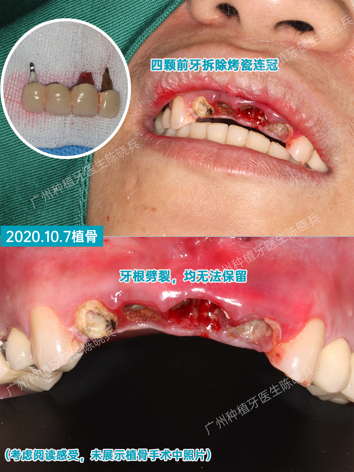 目前已经进行到三期取模,两周后就可以戴冠,后续再处理其他牙齿