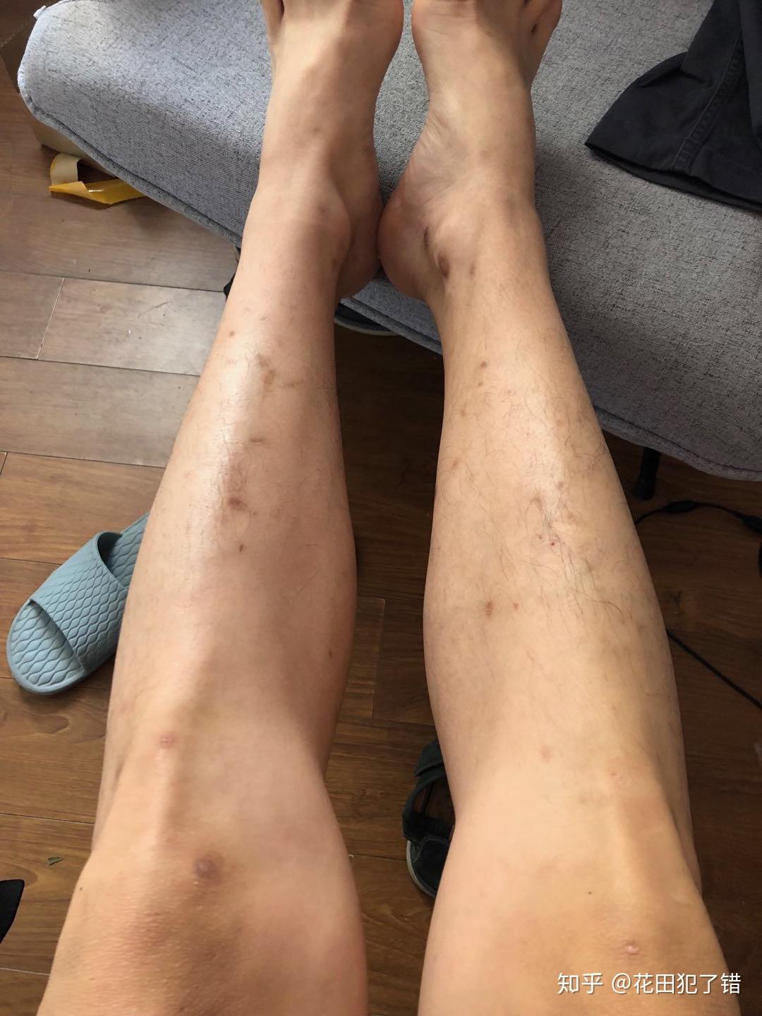 满腿的疤痕怎么消除实测