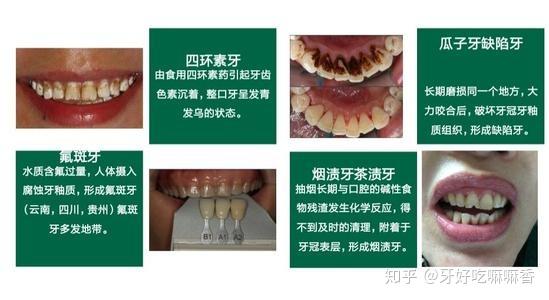 牙齿变色的原因有很多,如先天性因素和后天因素,比较常见的就有氟斑牙