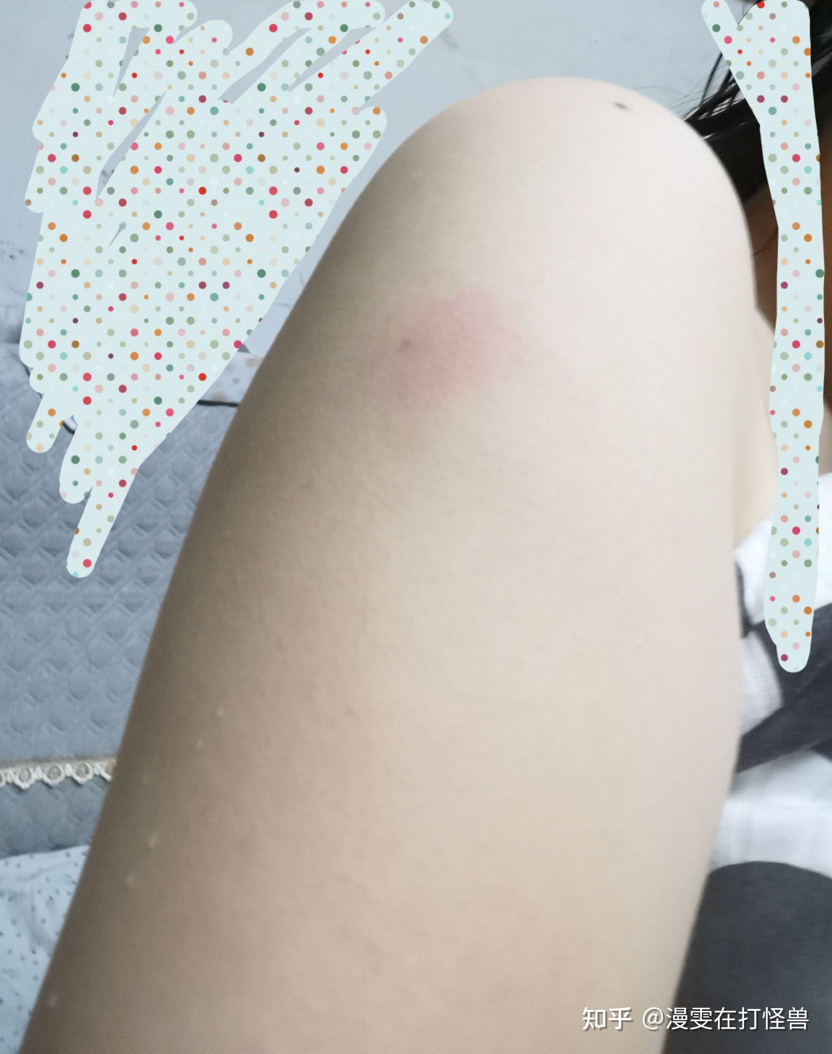 第三针新冠疫苗打完后,打针的地方红肿,痒,3天都没好(前两针都没任何