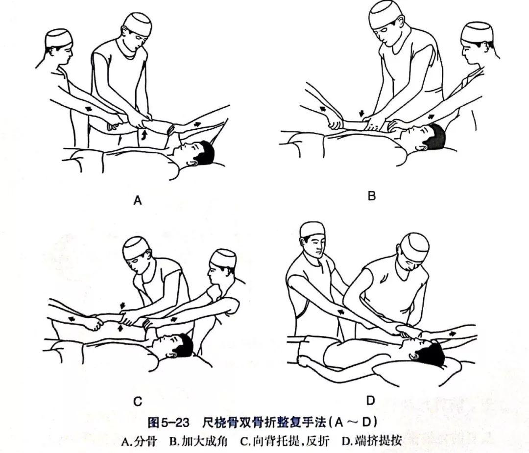 史密斯骨折手法复位图片