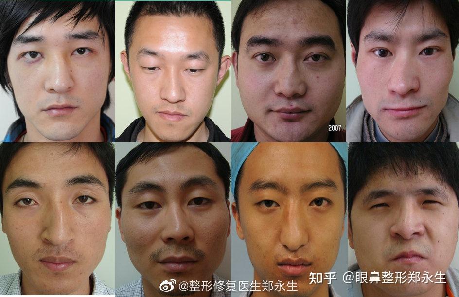 歪鼻分几种类型