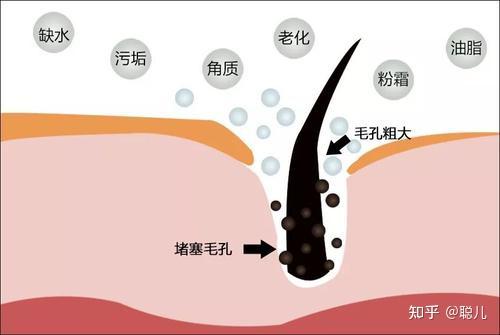 二,护肤对毛孔的影响脸部毛孔分为四区域,t区(鼻子 额头)的毛孔是朝上