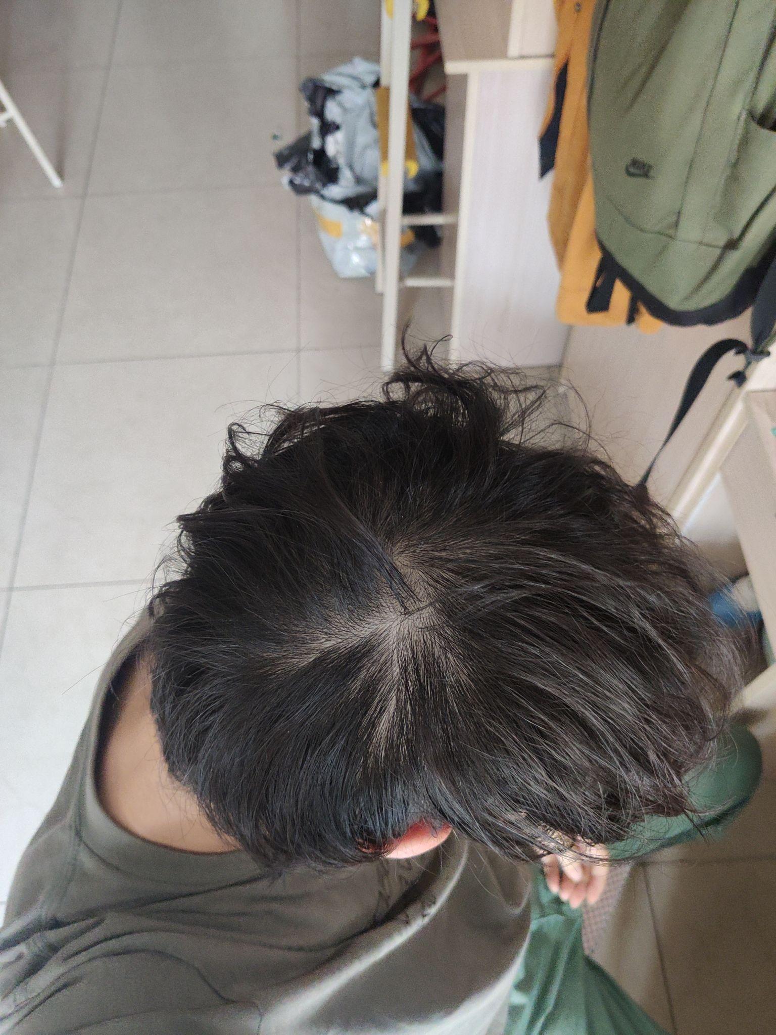 发旋处头发太少了！！！，我是不是要秃了，怎么办啊！？ - 知乎