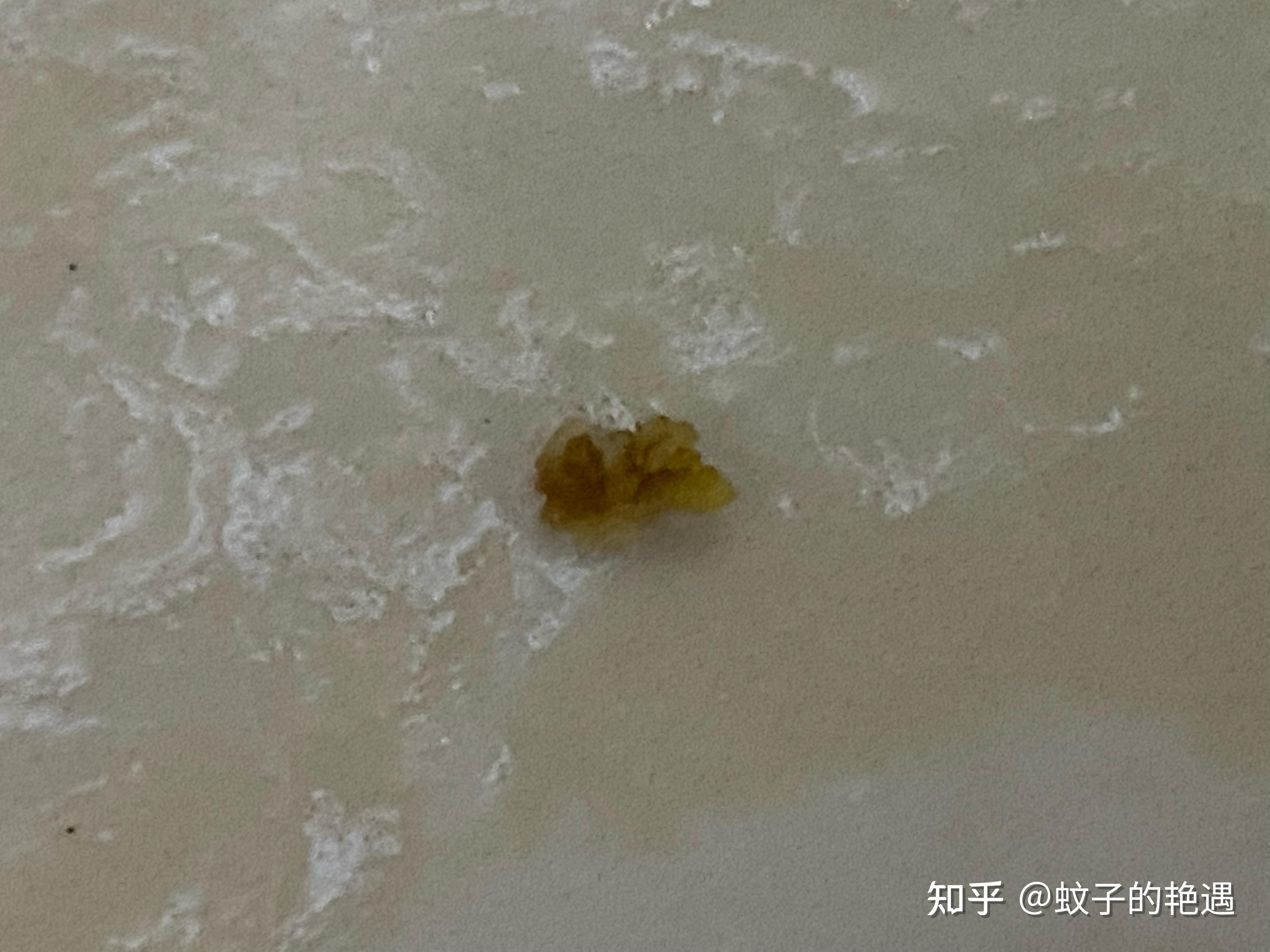 肾结石尿出来的照片图片