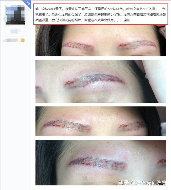 皮秒洗眉案例(图片源于网上)