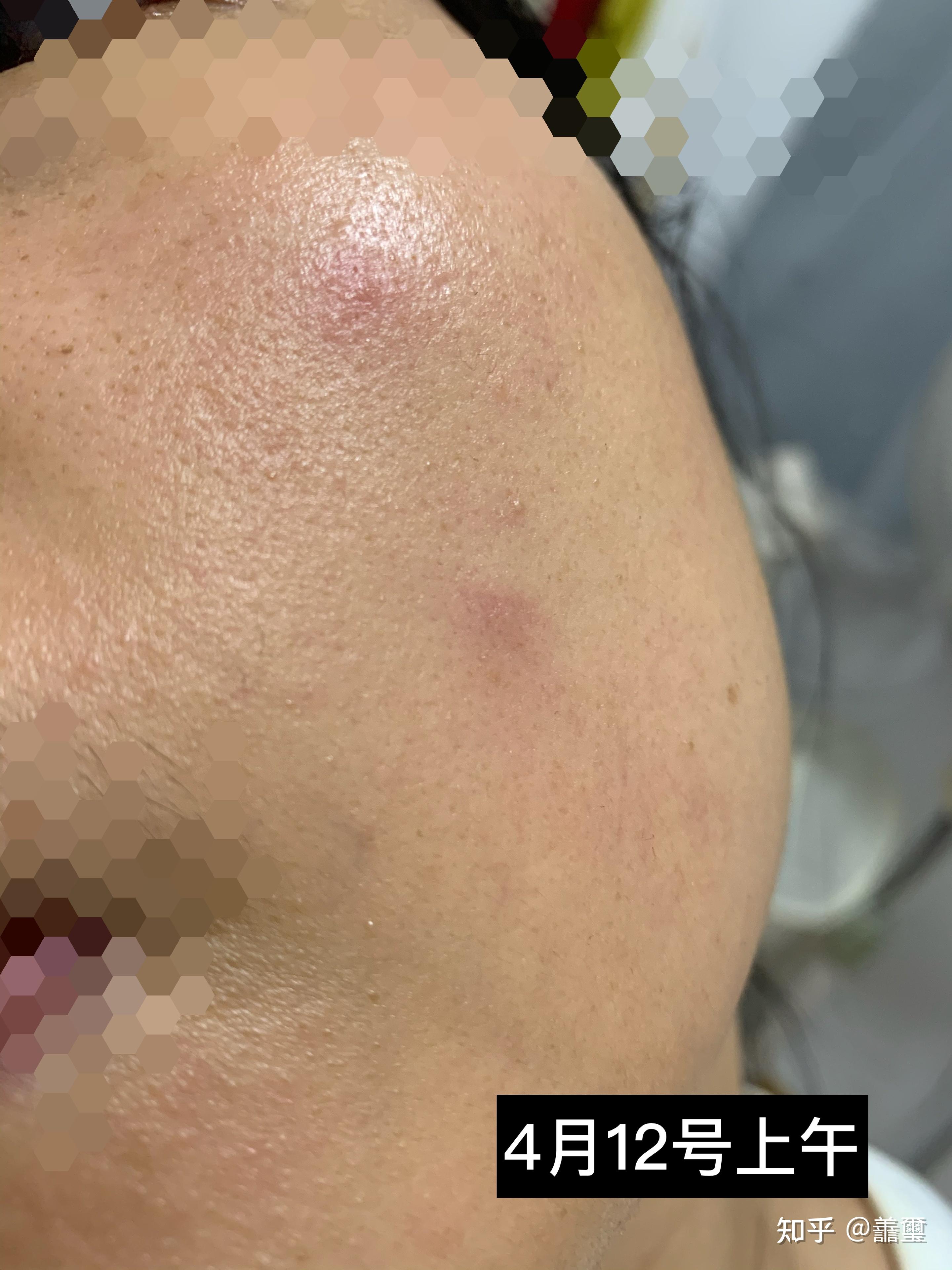 过敏,玫瑰痤疮,激素脸我的经验分享