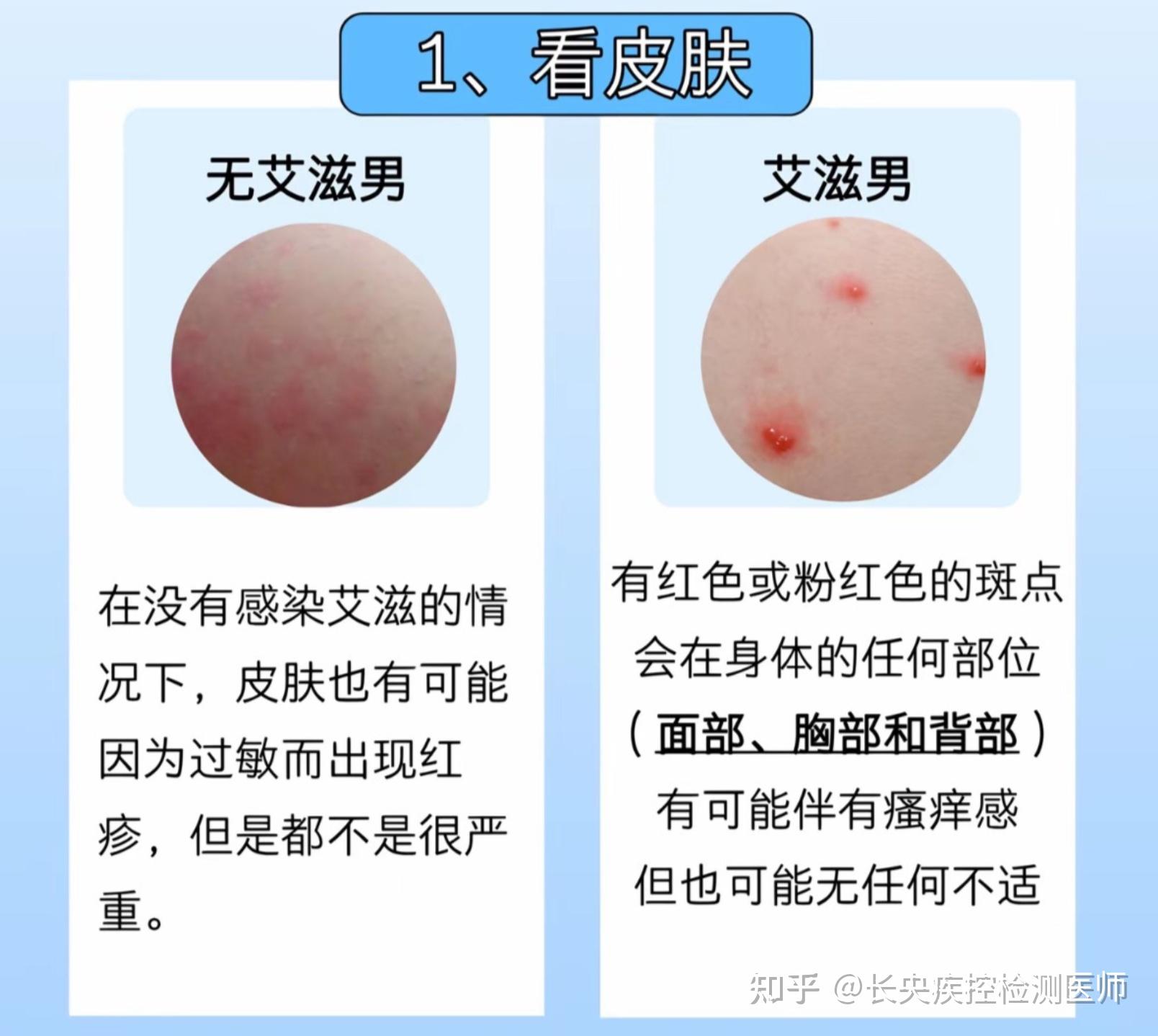 这个是毛囊炎吗还是HIV初期的皮疹? - 知乎