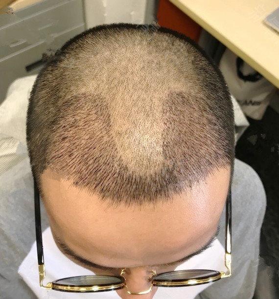 上海植发|男生有头发的重要性!