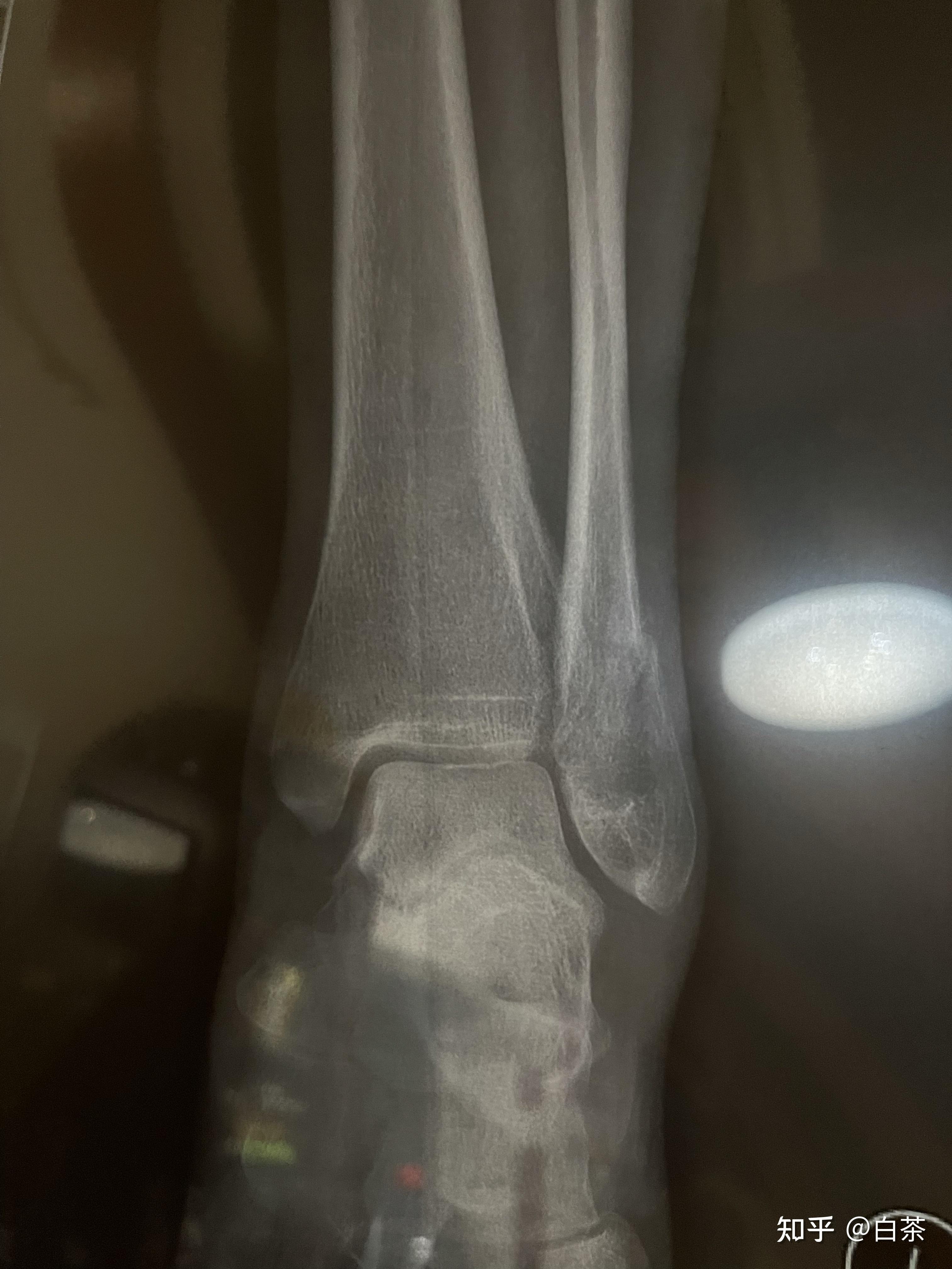 脚踝骨裂 x光片图片