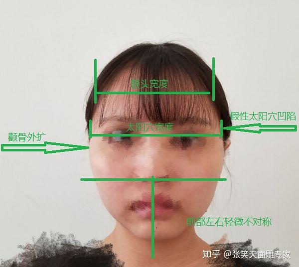 头大脸大颧骨高整个脸不对称削颧骨可以让脸看起来正常吗