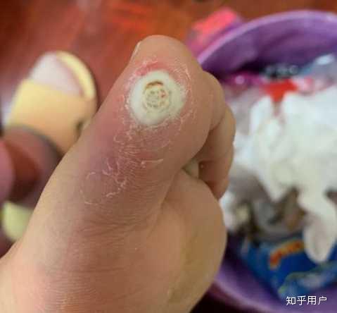 贴完鸡眼贴以后把白色的皮撕掉了然后又贴了个鸡眼贴贴了两天以后起了