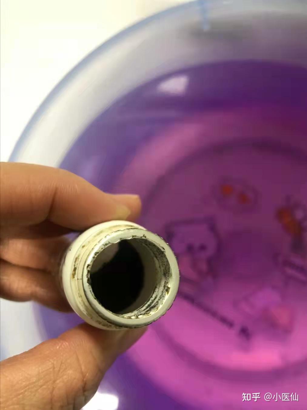 每天会坐浴10分钟,将高锰酸钾稀释到淡紫色就好啦,不要怕染pp,裤子一