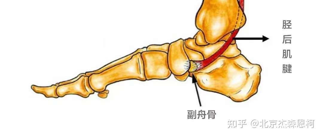 脚内侧疼是怎么回事副舟骨疼痛