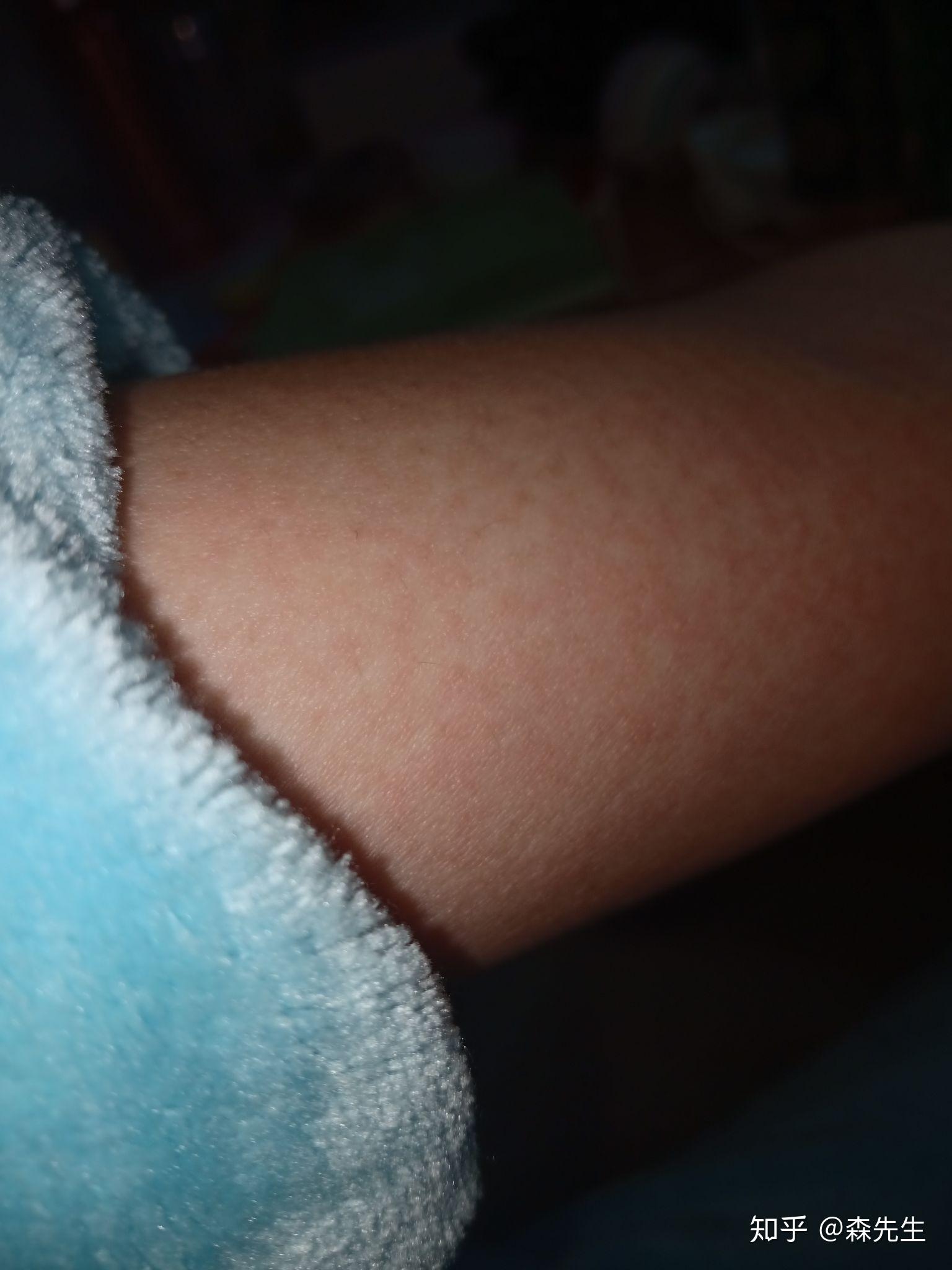 酒精过敏的特征是什么