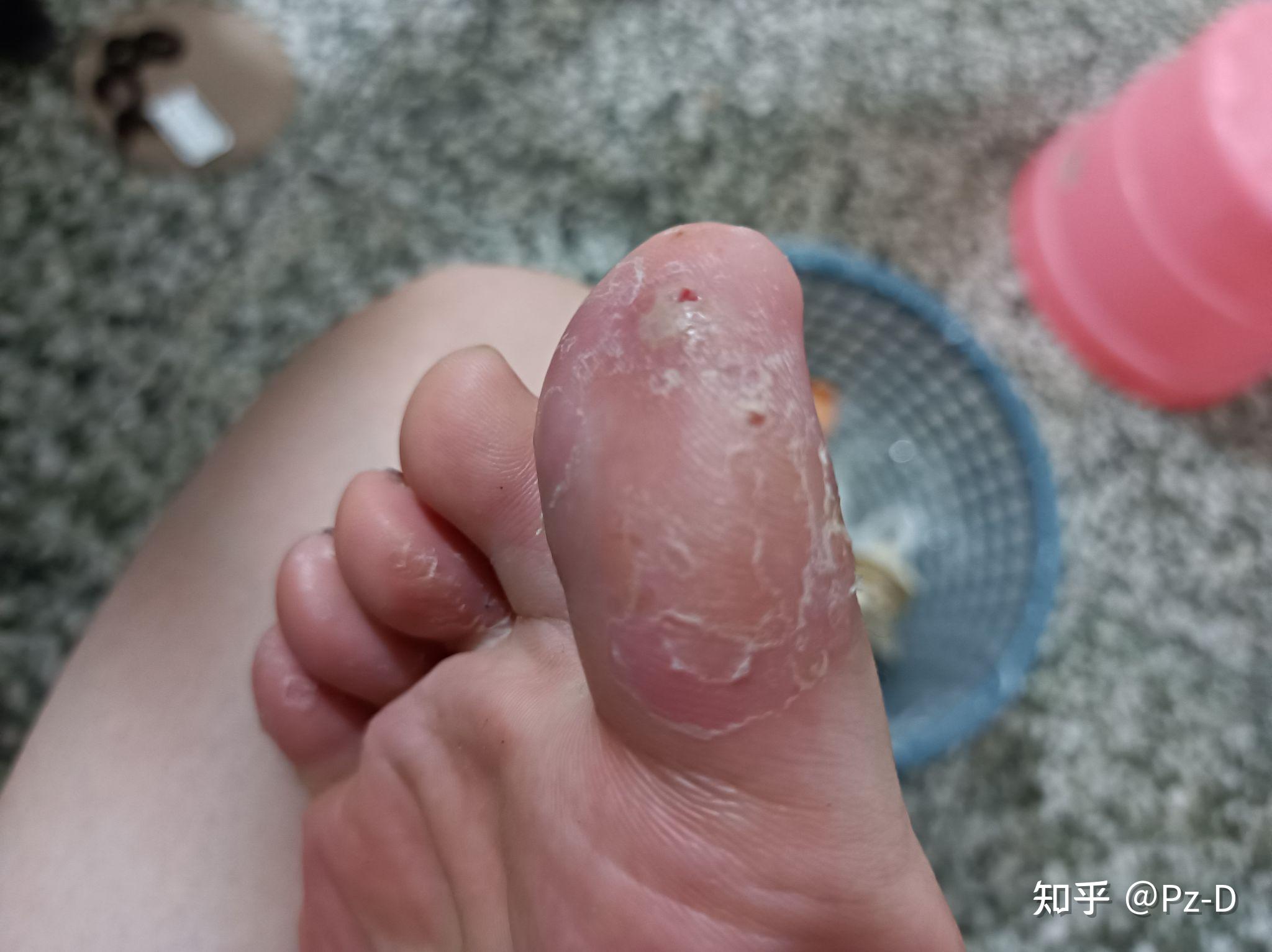 在学校的日子里也买过足光散之类的东西来泡脚,除了把脚泡的脱了一层