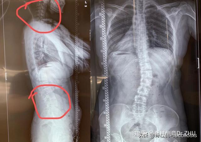 27岁腰椎27度 椎体旋转骨盆前倾颈椎反弓