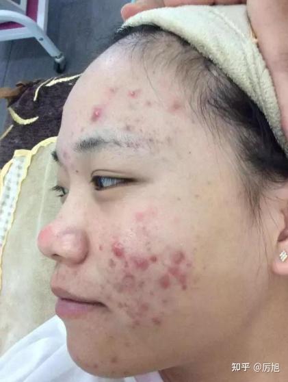 40岁后女性长痘痘该怎么护理