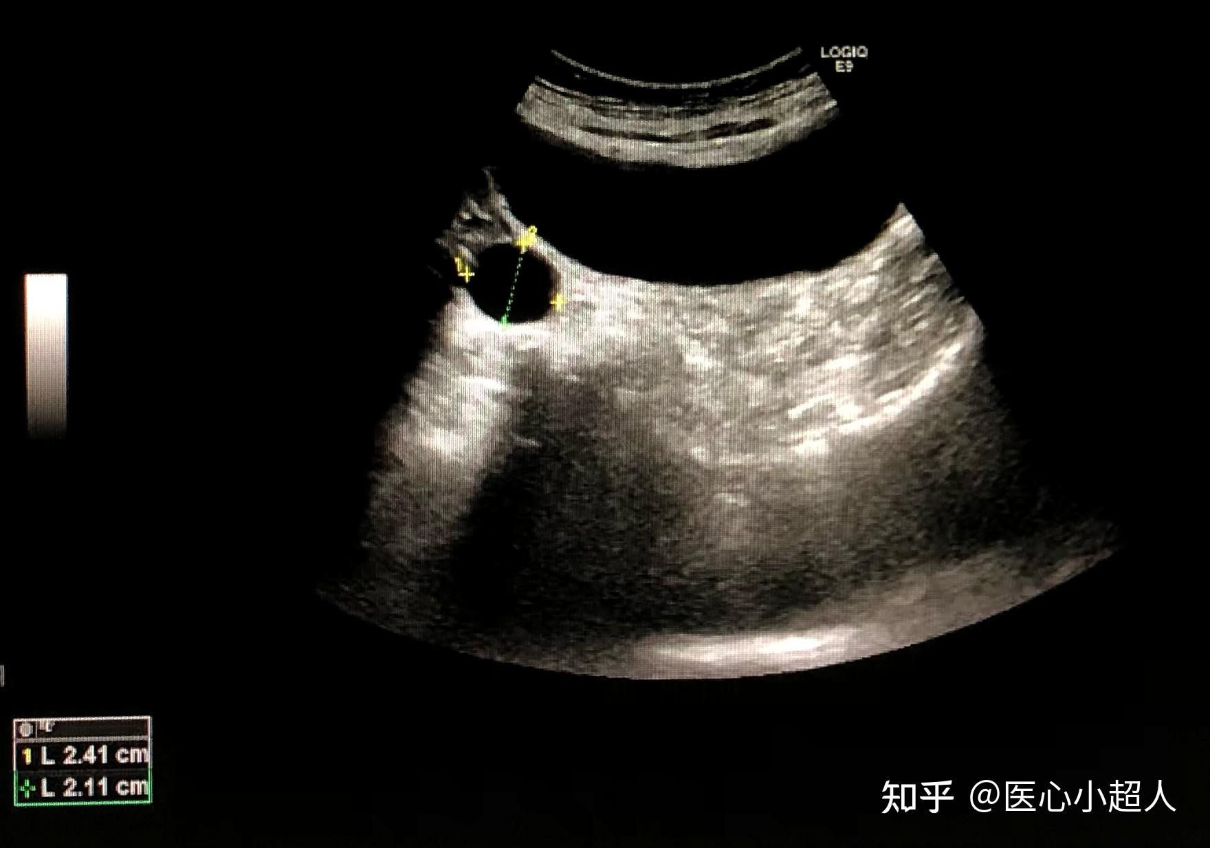 【附图】右侧卵巢乳头状囊腺癌CT检查显像_内分泌学 | 天山医学院