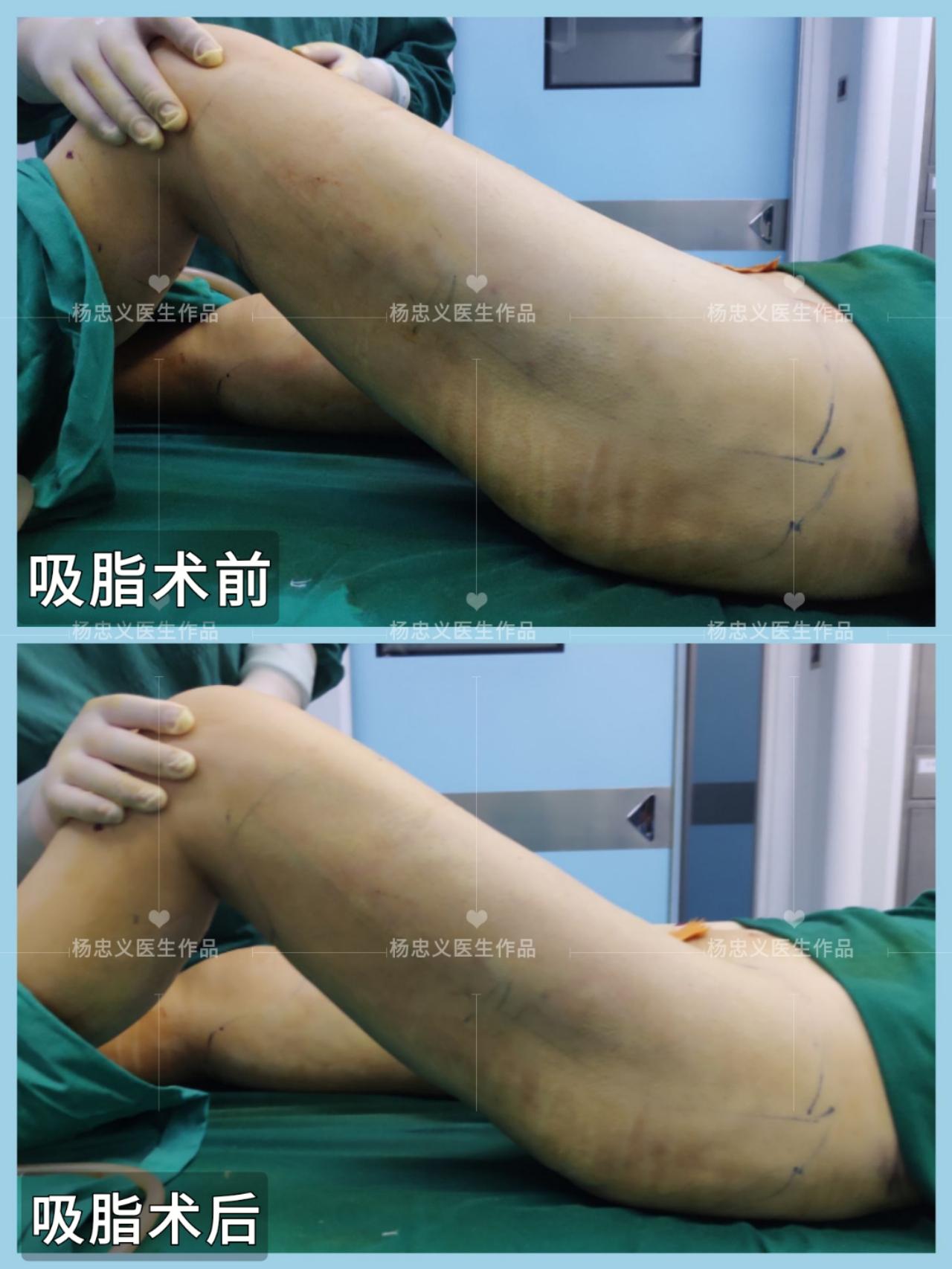 如何减大腿脂肪 v2-394c18dccaf5d4d9032cdd85a84bc3ca_1440w.jpg?source=172ae18b