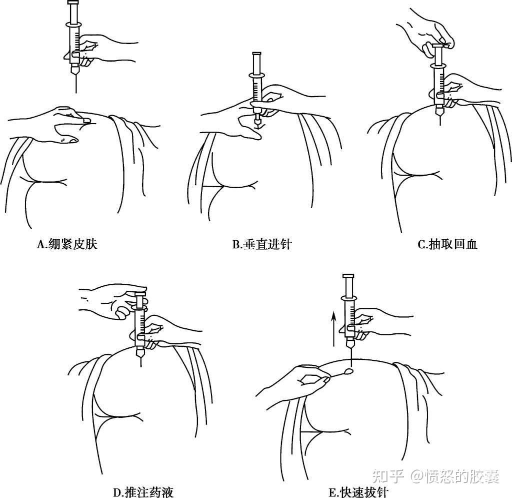 打屁股针为啥打针前医生要滋掉一点药水不怕剂量不够吗