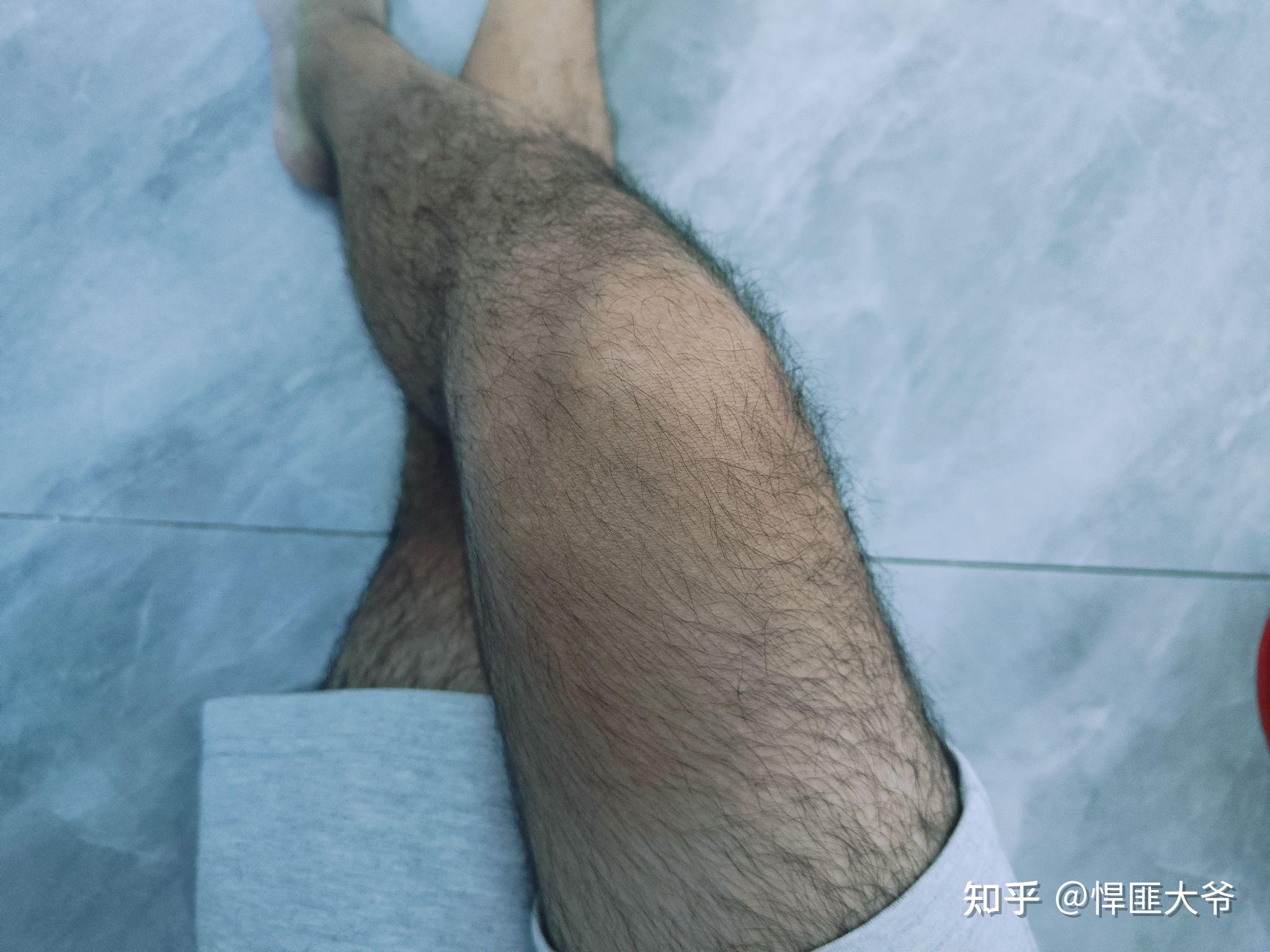 男生腿毛浓密怎么办