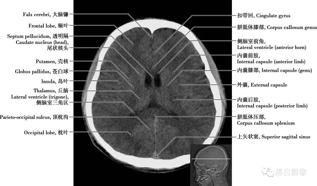 详细标注版!颅脑CT正常解剖图谱 - 知乎