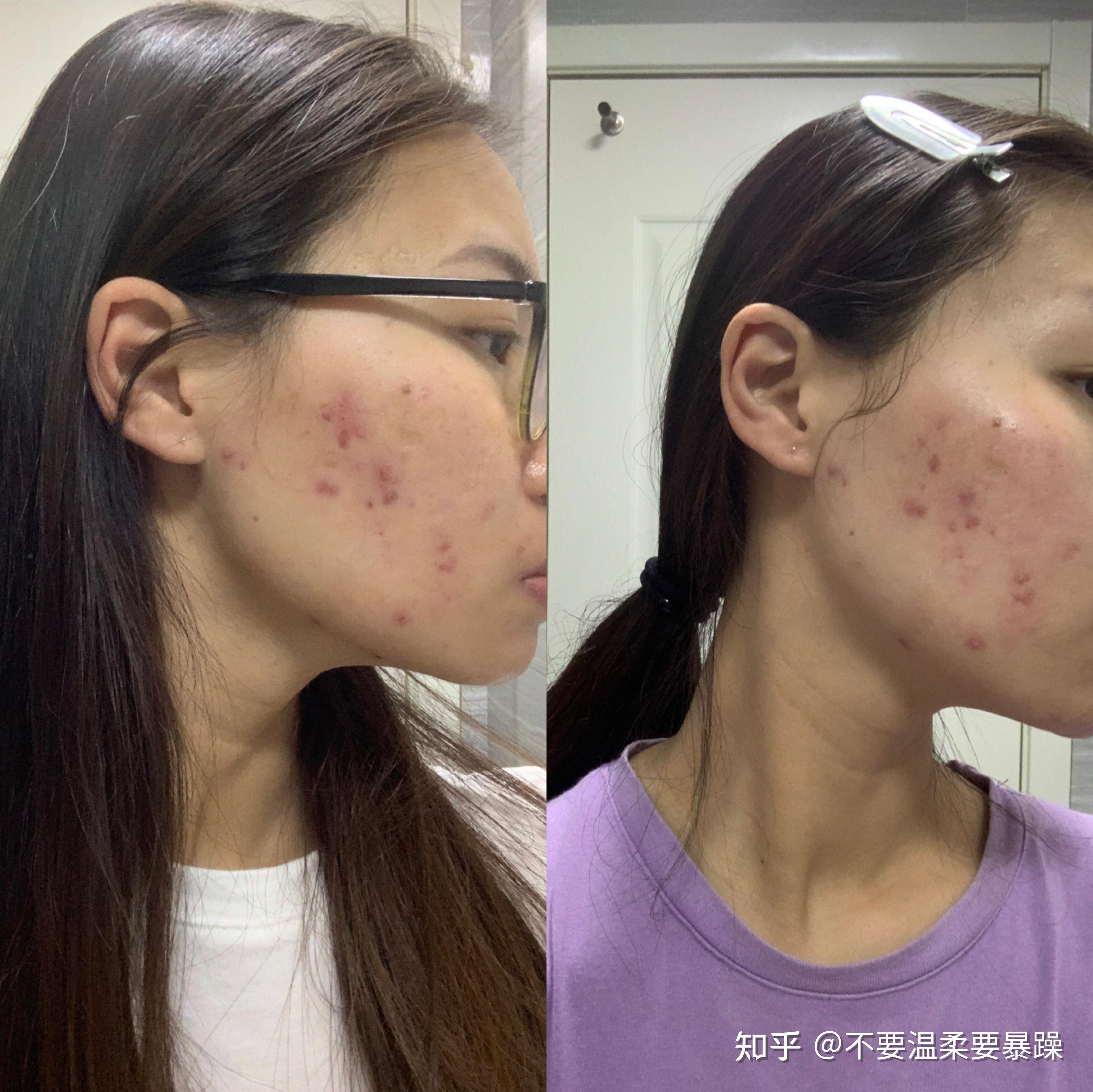 你们试过最牛逼的去痘印方法是什么? - 知乎