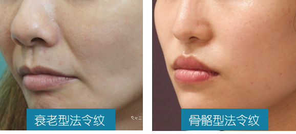 怎么快速消除法令纹 知乎