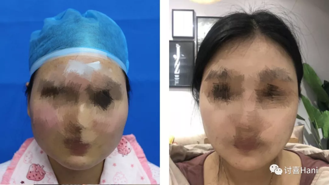 讨喜hani大脸大骨架离美只有一步之遥